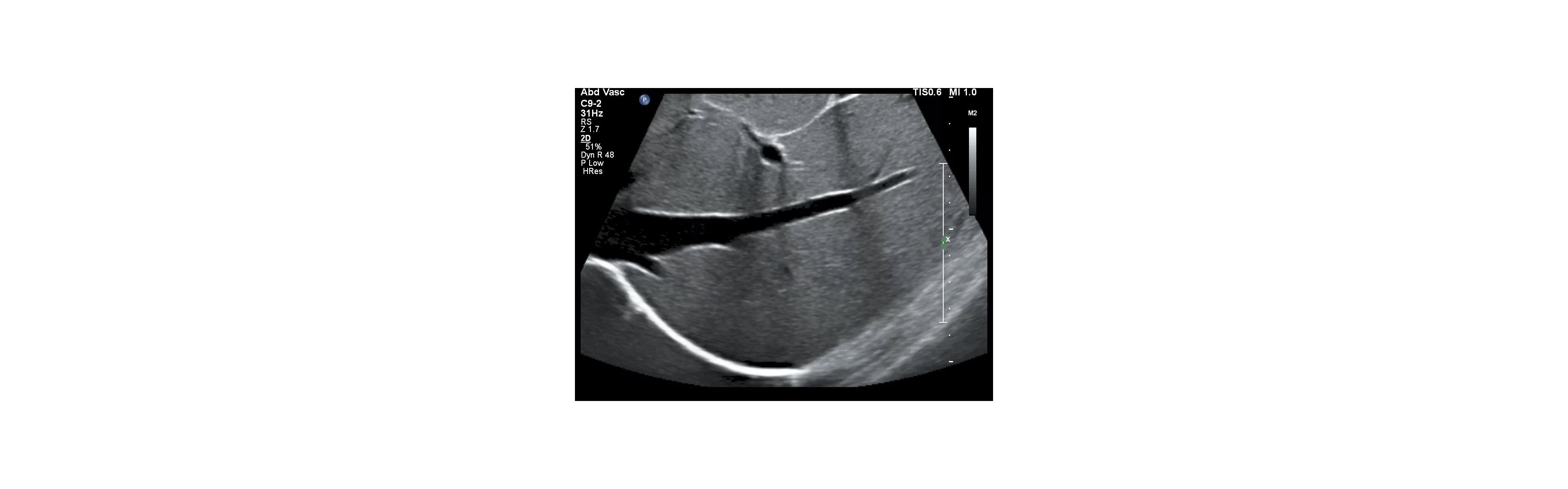 Ultrasound lever