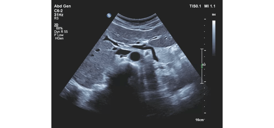 echo abdominal