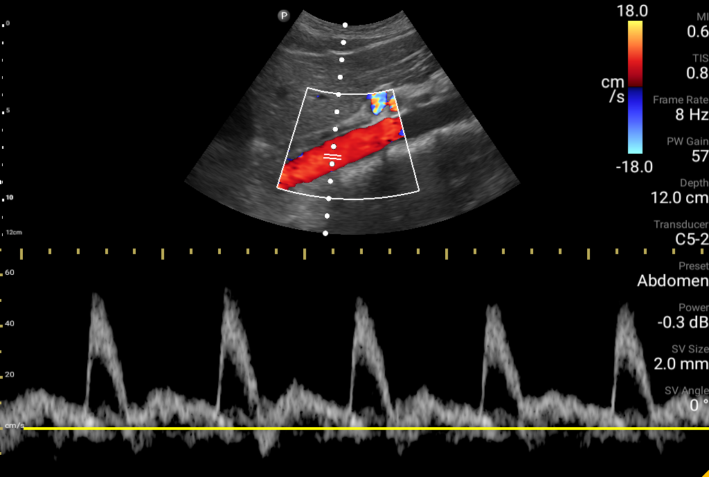 Longitudinal Aorta with Color and PW Doppler Longitudinal Aorta with Color and PW Doppler